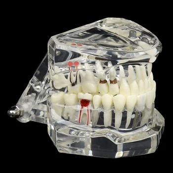 Обучение Реставрации Зубных Имплантатов Мостовидным Протезом для Изучения Зубоведения